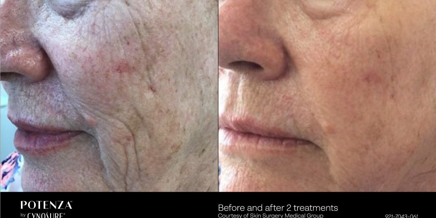 Combining Radiofrequency Energy and Microneedling for Skin Tightening